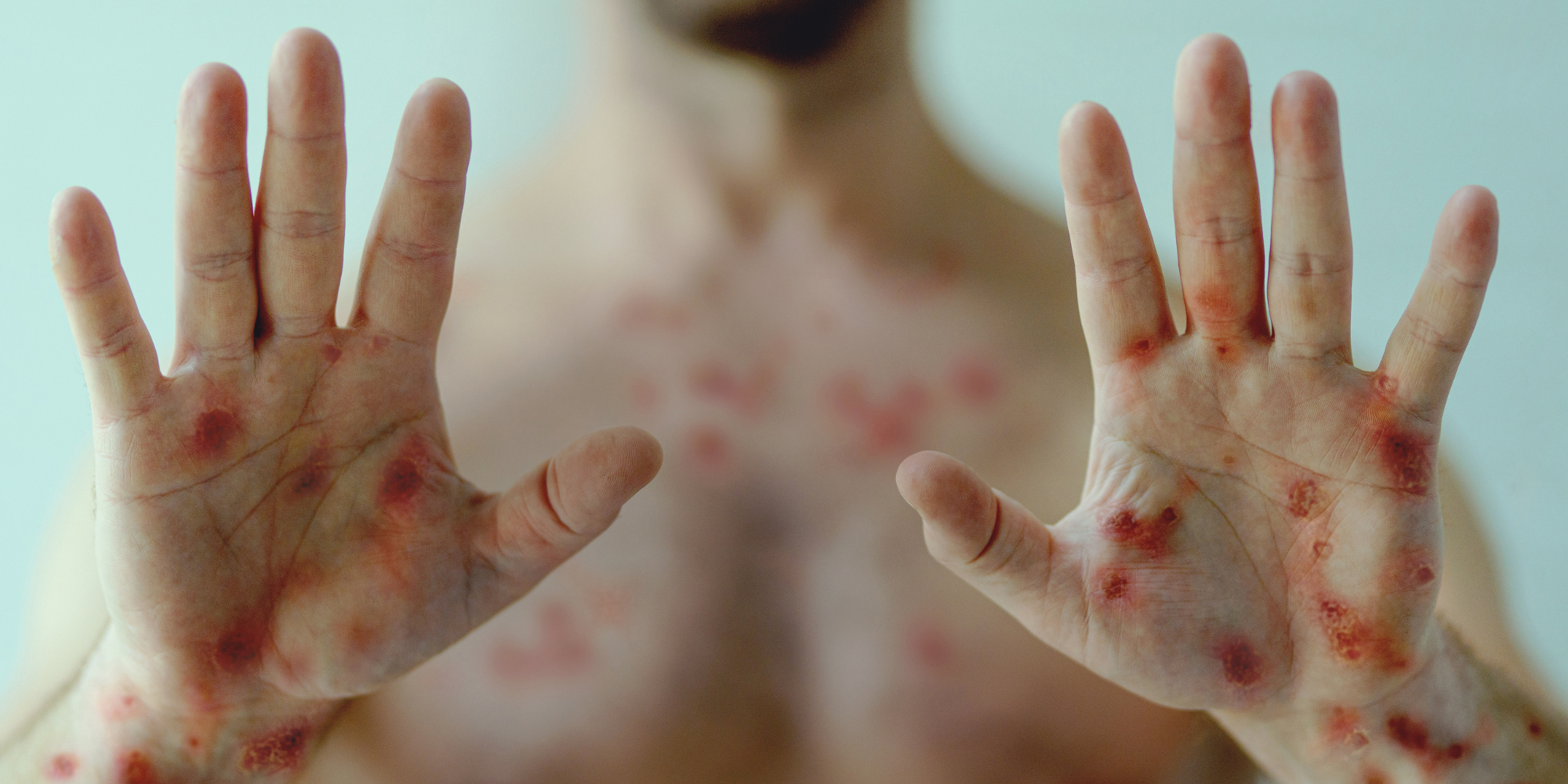 Eine Person ohne Hemd hält ihre Hände hoch, die mit roten Flecken und Läsionen bedeckt sind. Ähnliche Flecken sind auf der Brust zu sehen, was auf eine Hauterkrankung oder einen Ausschlag hinweist. Das Gesicht der Person ist unscharf.